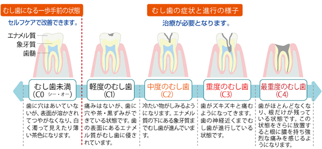 虫歯の段階別症状